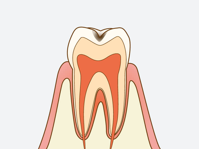 C1【エナメル質の虫歯】