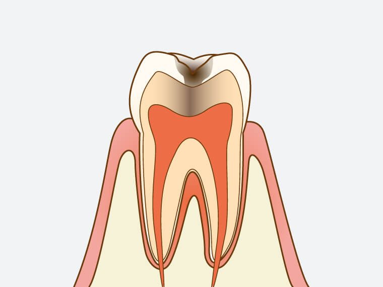 C2【象牙質の虫歯】