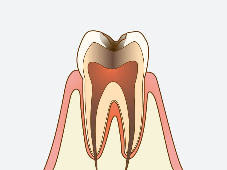 C3【神経まで達した虫歯】