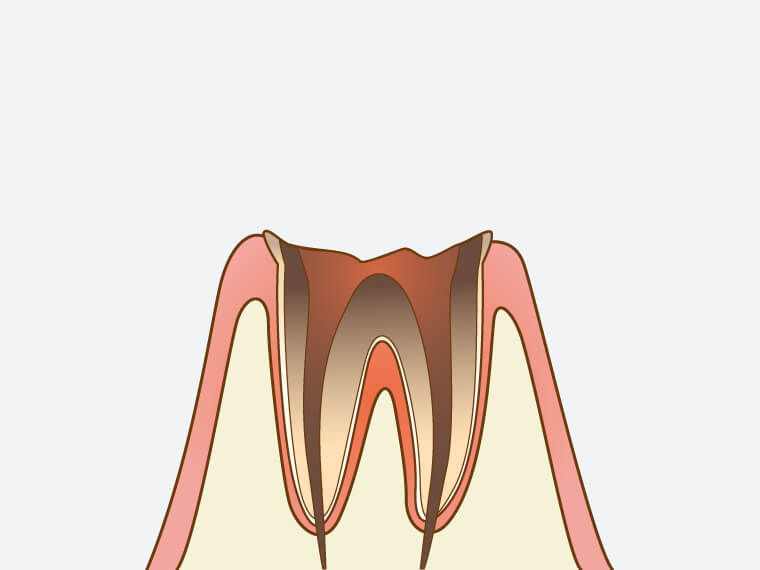 C4【歯根まで達した虫歯】