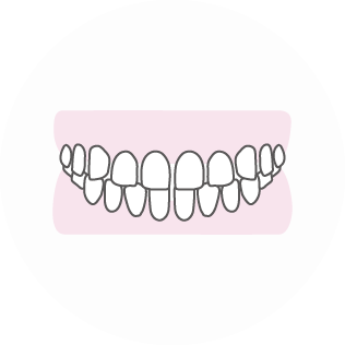 すきっ歯 歯の間のすき間が目立つ