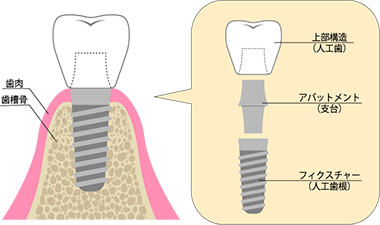 インプラントの構造をご存じですか?