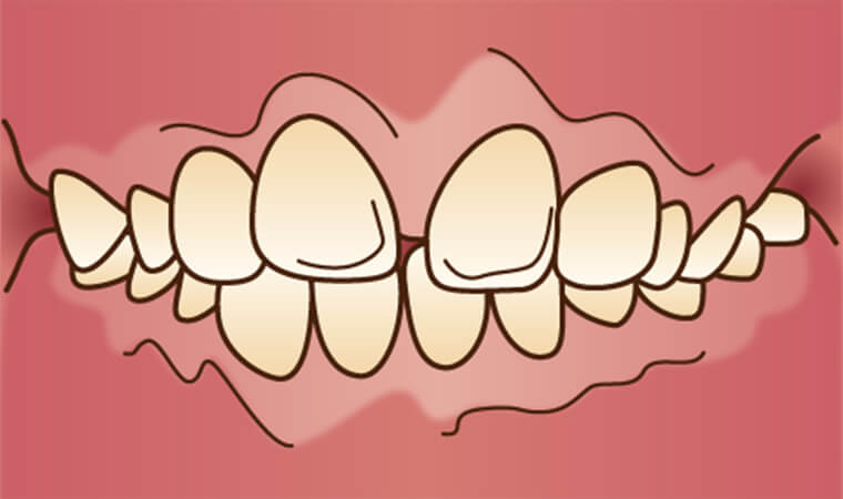 上顎前突（じょうがくぜんとつ）