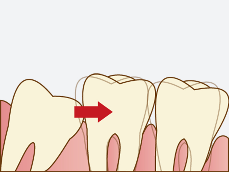 親知らずは早めに治療しましょう