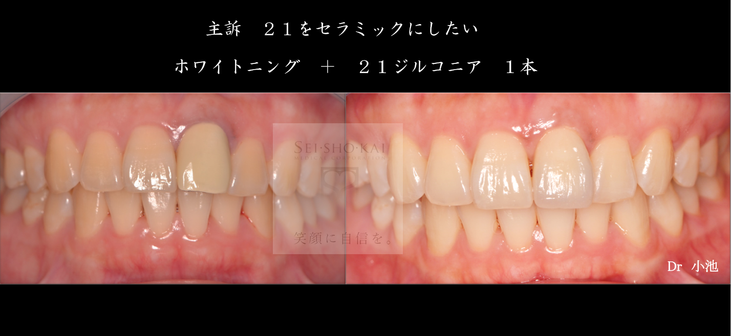 ジルコニアクラウン（症例）