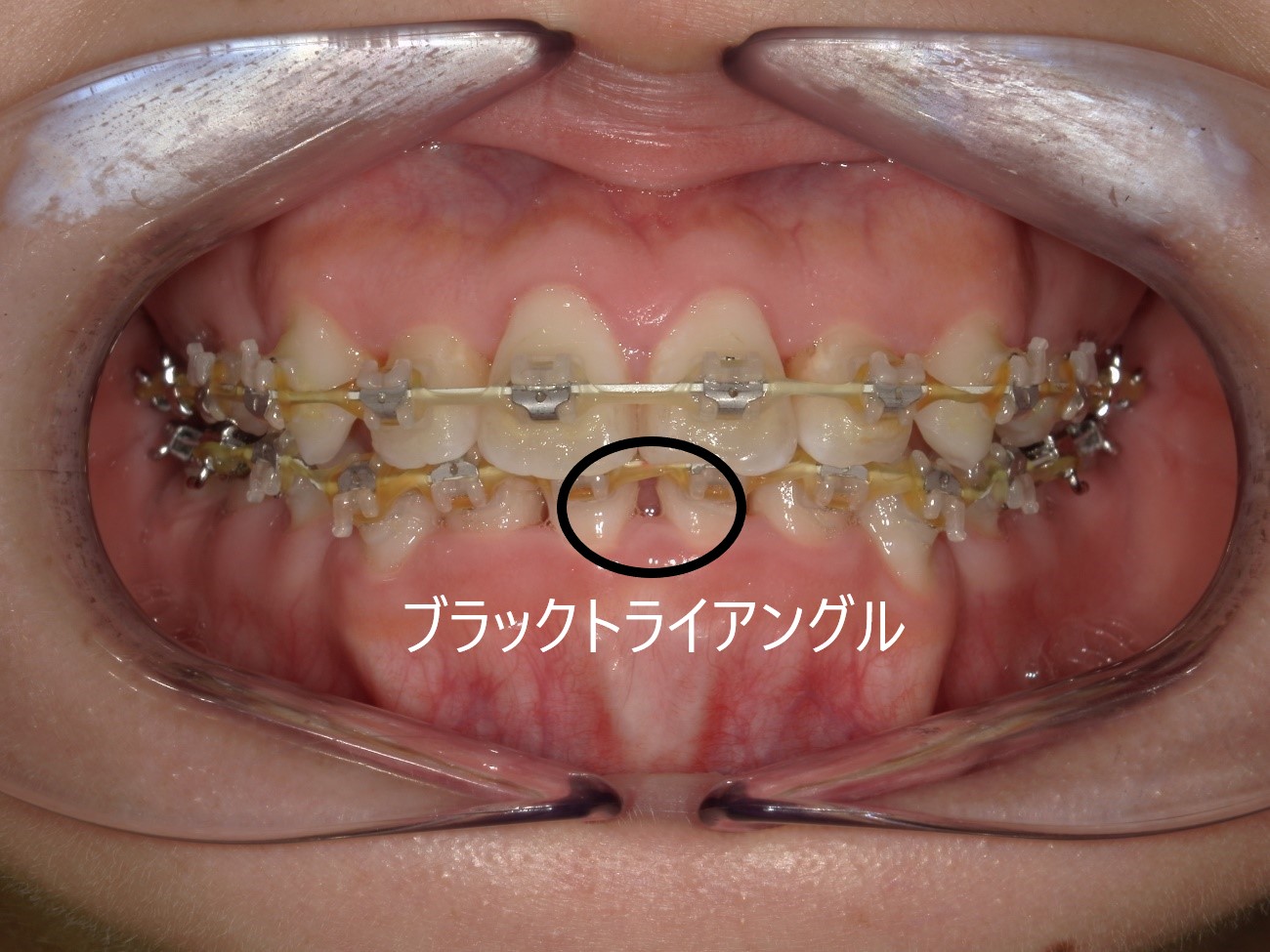 矯正中のブラックトライアングルについて