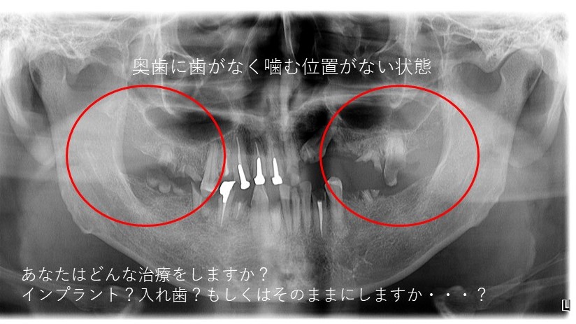 歯を失った時の治療法とは