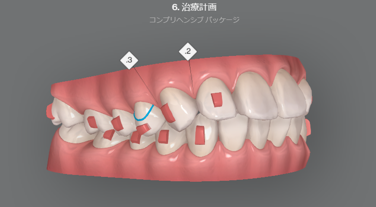 インビザラインについてよくある質問