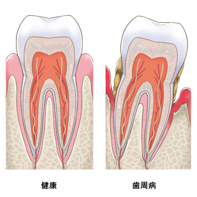 歯の骨が溶ける病、、、
