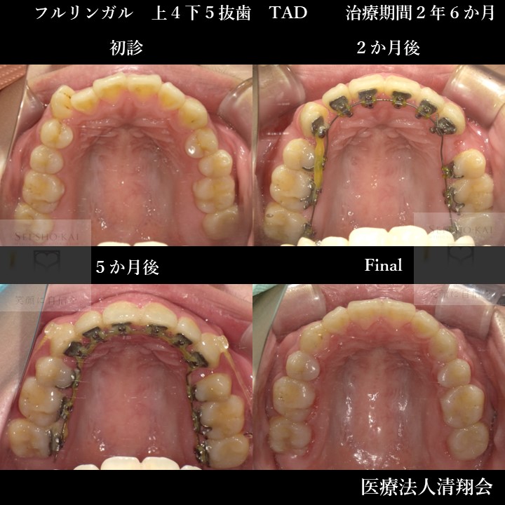 誰にもバレずに矯正治療！裏側矯正