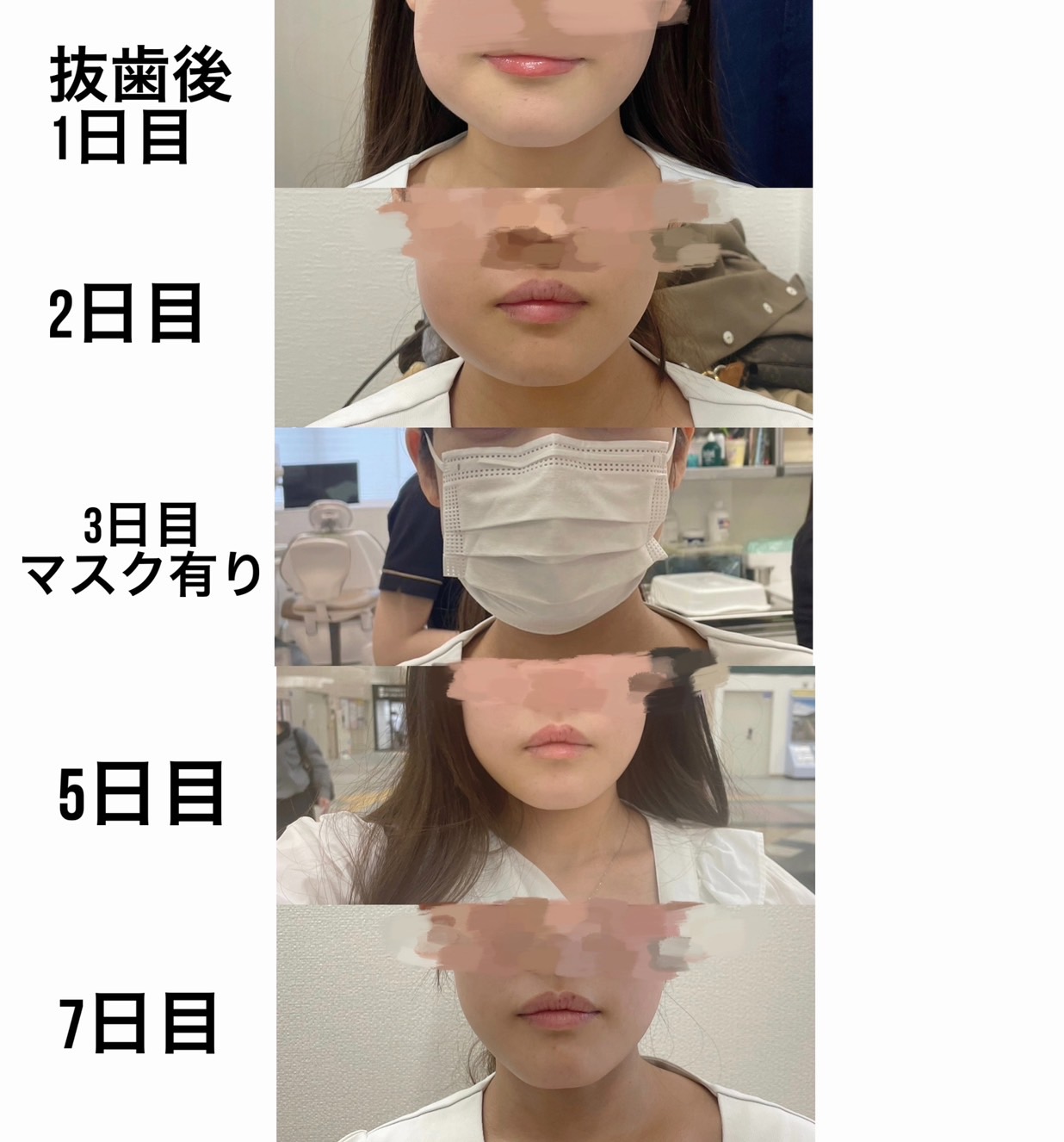 親知らずの抜歯　経過