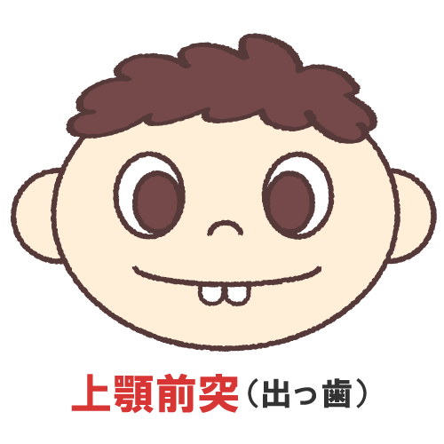 お子さんの出っ歯の原因とそのリスクについて
