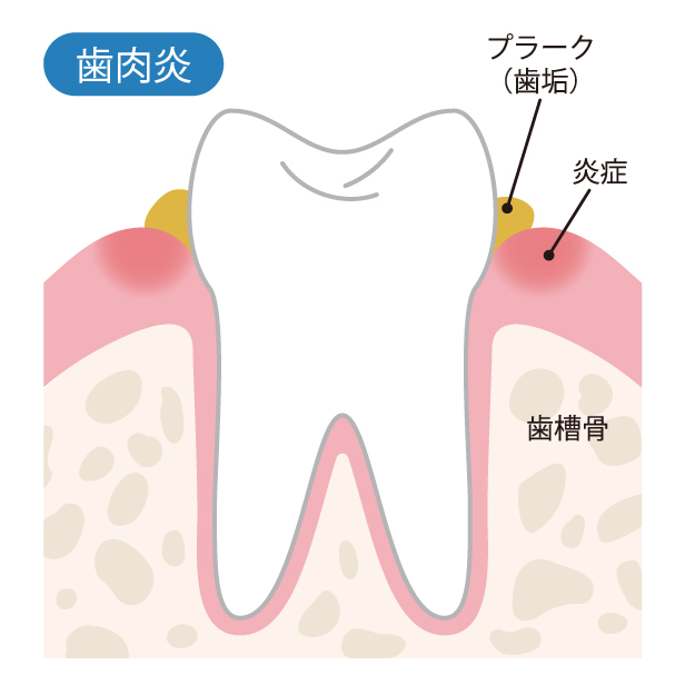 歯列矯正中に歯肉炎が起きやすい理由とは？