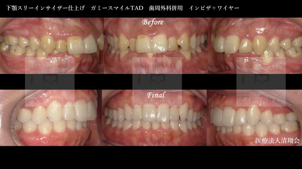 矯正治療と歯周外科処置を組み合わせて歯ぐきの見え方が改善した症例